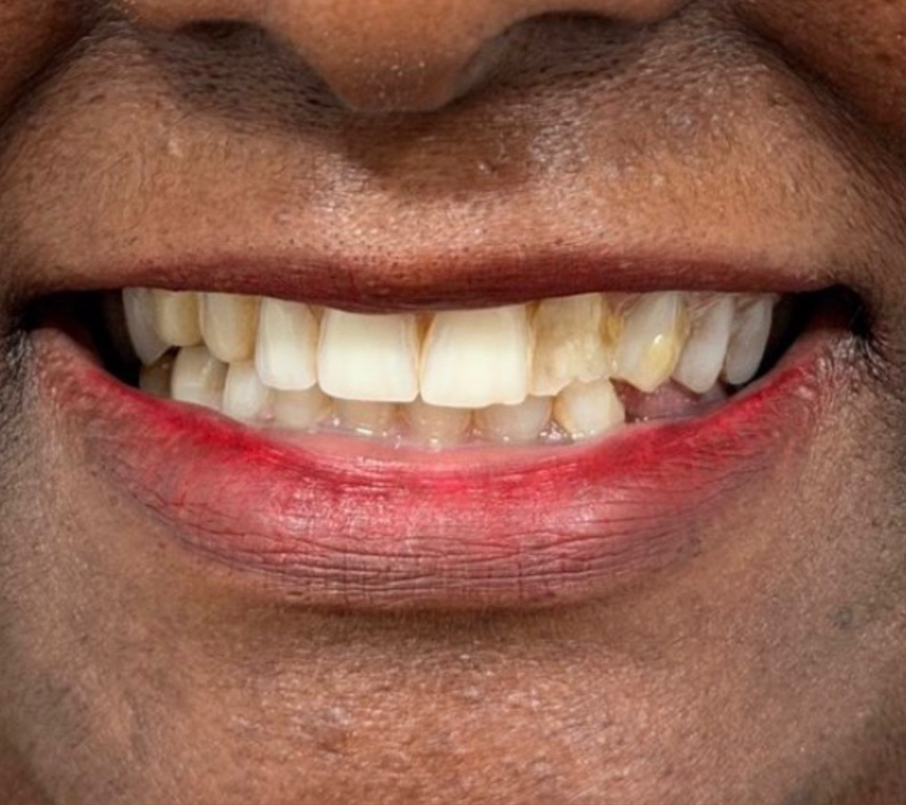 Sorriso antes do tratamento