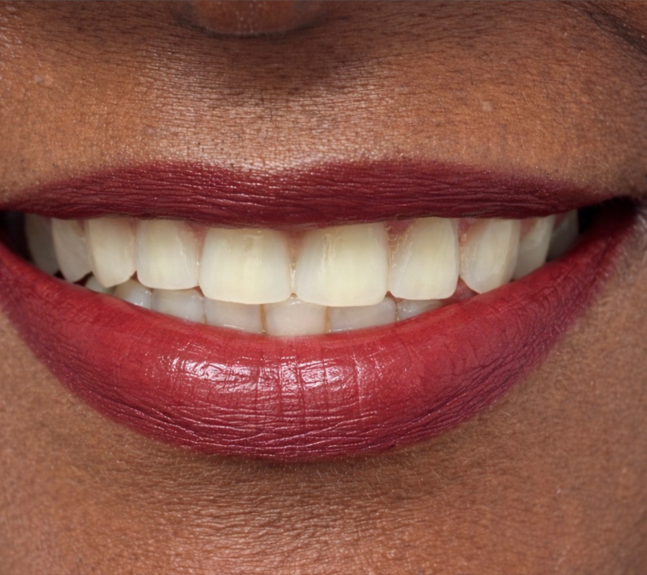 Sorriso depois do tratamento
